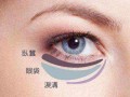 下眼袋如何消除 这几个办法最有效